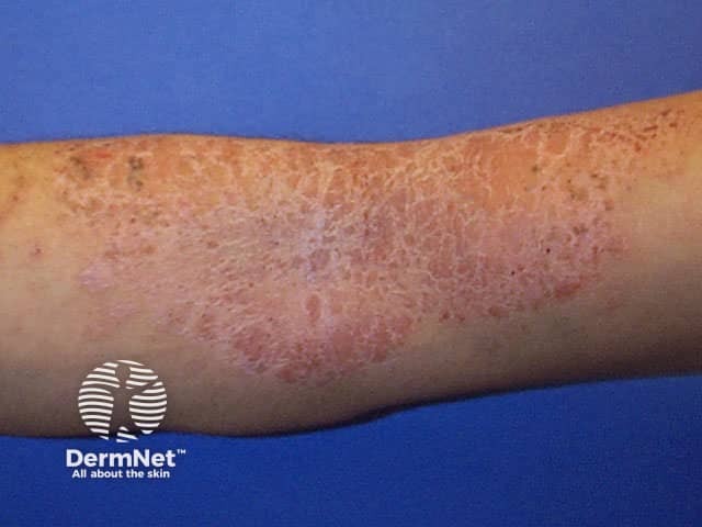 Atopic dermatitis