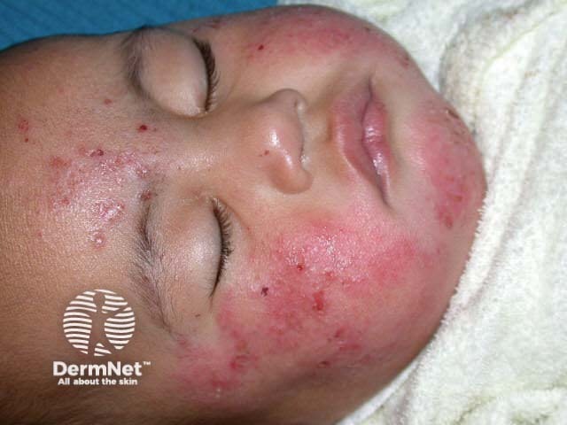 Atopic dermatitis