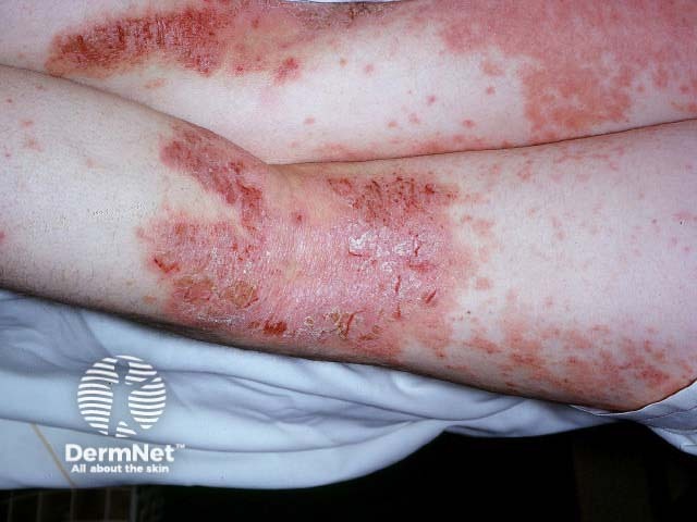 Atopic dermatitis