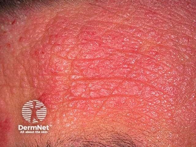 Atopic dermatitis