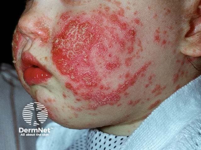 Atopic dermatitis