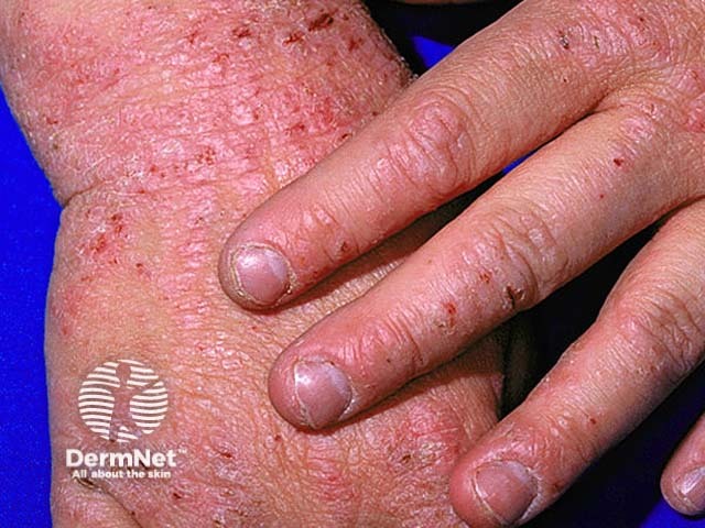 Atopic dermatitis