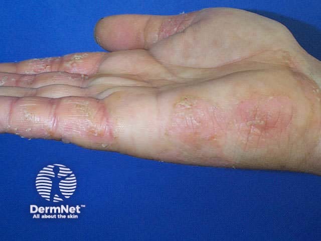 Atopic dermatitis