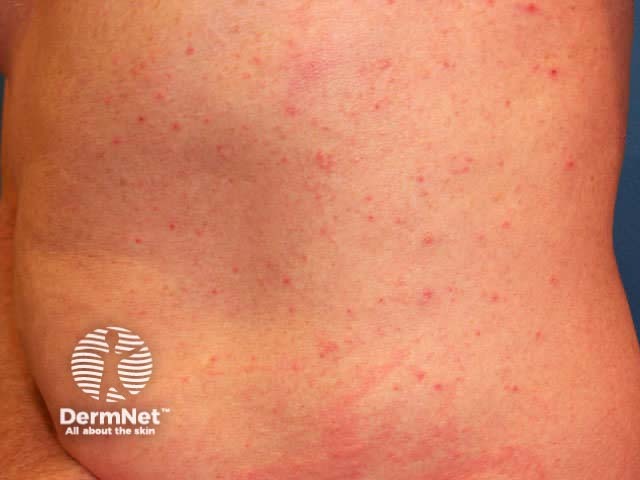 Autosensitisation dermatitis