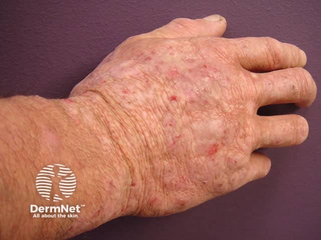 Atopic dermatitis