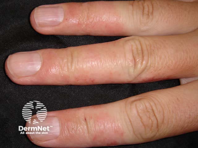 Hand dermatitis