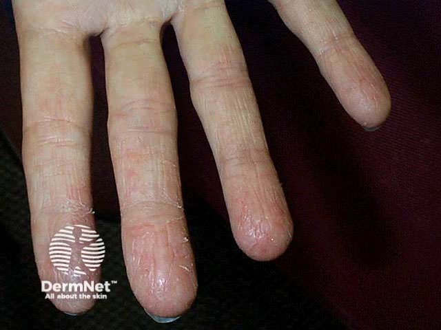 Hand dermatitis