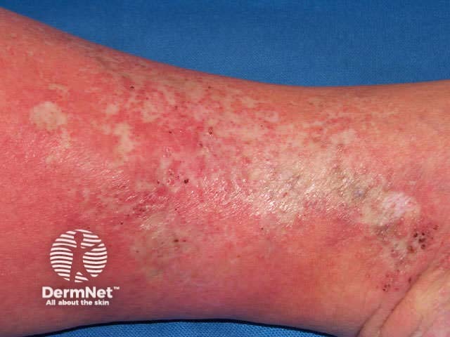 Venous eczema