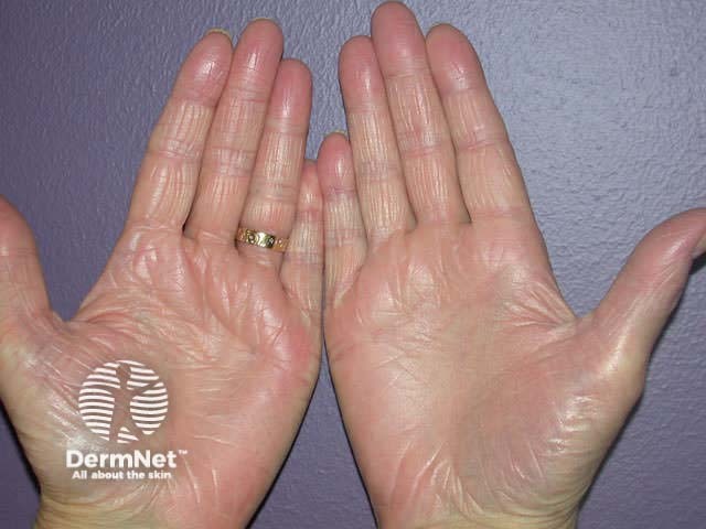 Keratoderma (psoriasis)