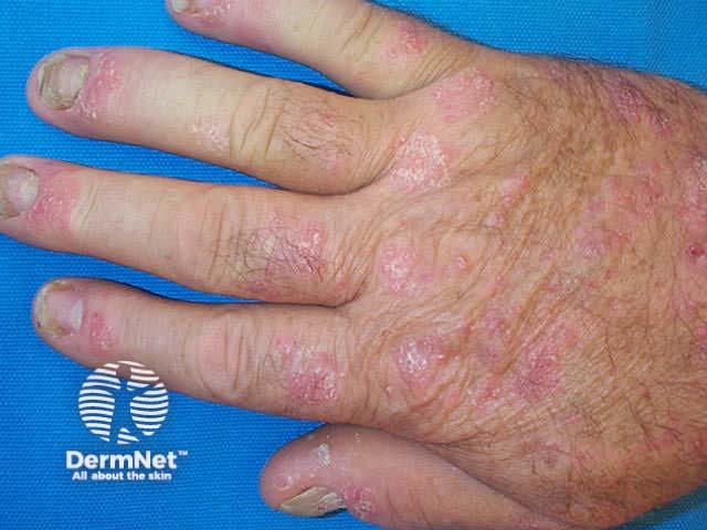 Chronic plaque psoriasis