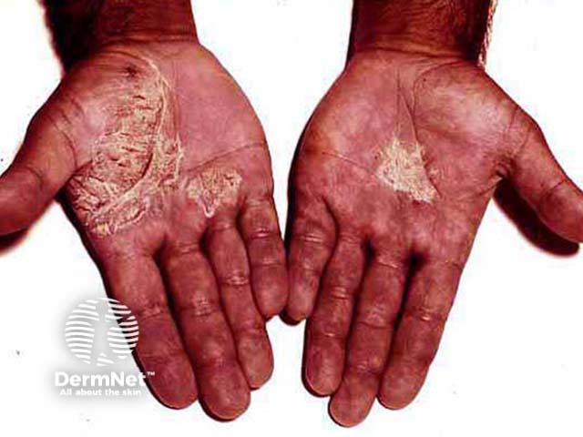 Palmar psoriasis