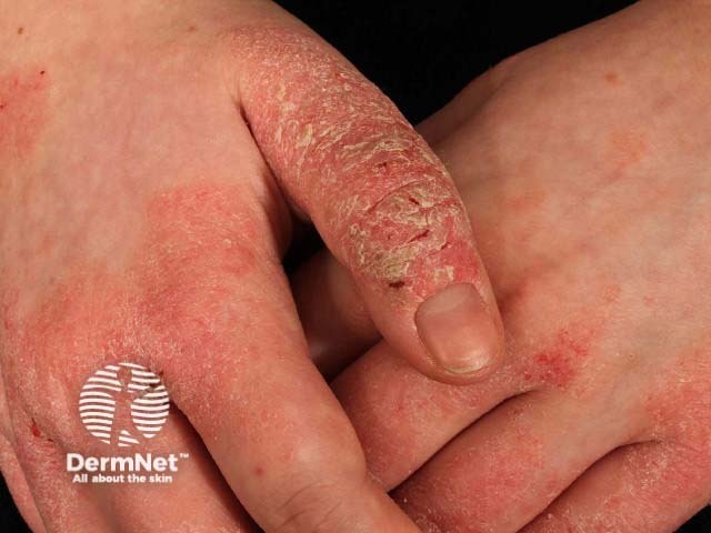 Hand dermatitis