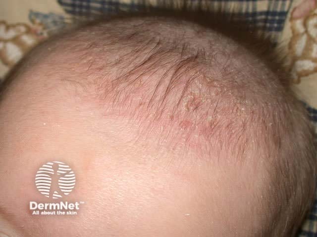 Infantile seborrhoeic dermatitis