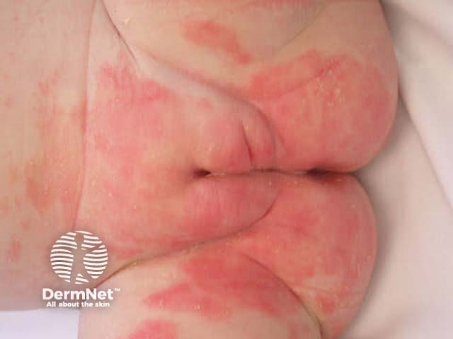 Infantile seborrhoeic dermatitis