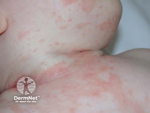 Infantile seborrhoeic dermatitis