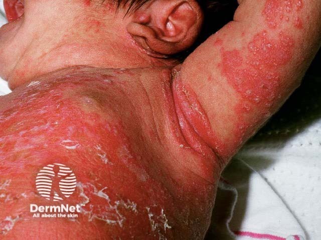 Infantile seborrhoeic dermatitis