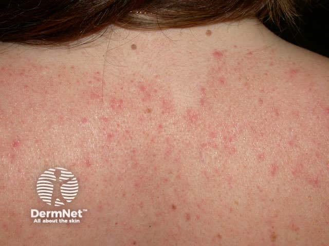 Seborrhoeic dermatitis