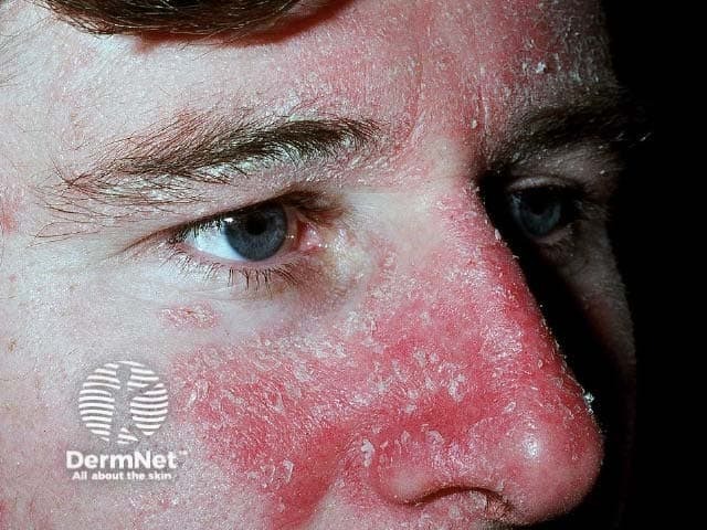 Seborrhoeic dermatitis