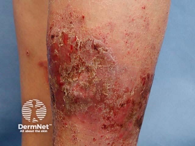 Subacute dermatitis