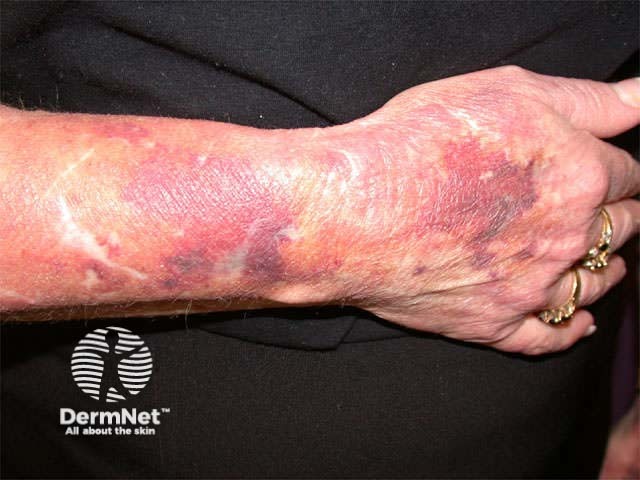 Steroid atrophy and purpura