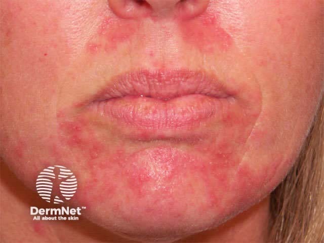 Perioral dermatitis