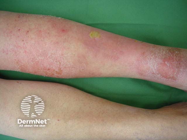 Venous eczema