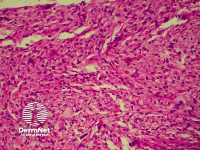 pathology of atypical fibroxanthoma