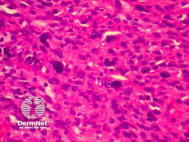 pathology of atypical fibroxanthoma