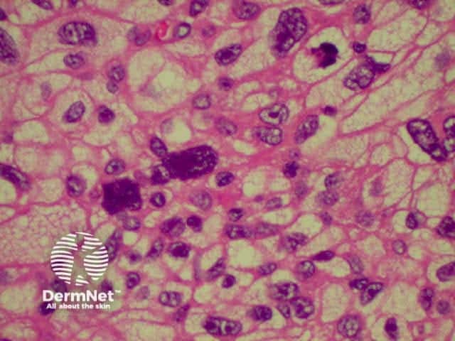 pathology of atypical fibroxanthoma