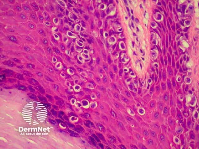 Pathology of melanoma