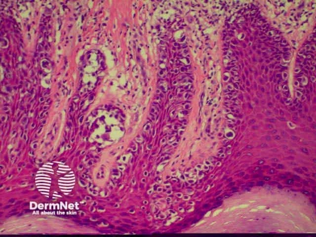 Acrolentiginous melanoma