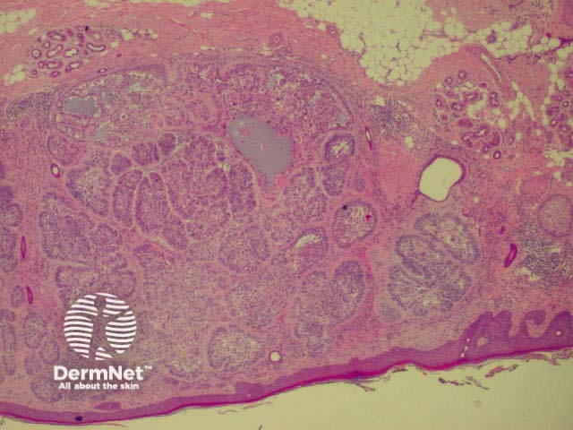 Pathology of BCC