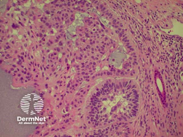 Pathology of BCC