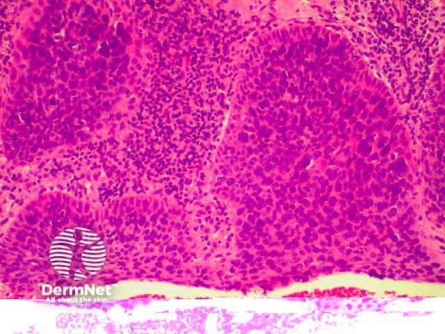 Pathology of in situ SCC