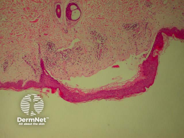 Bullous pemphigoid