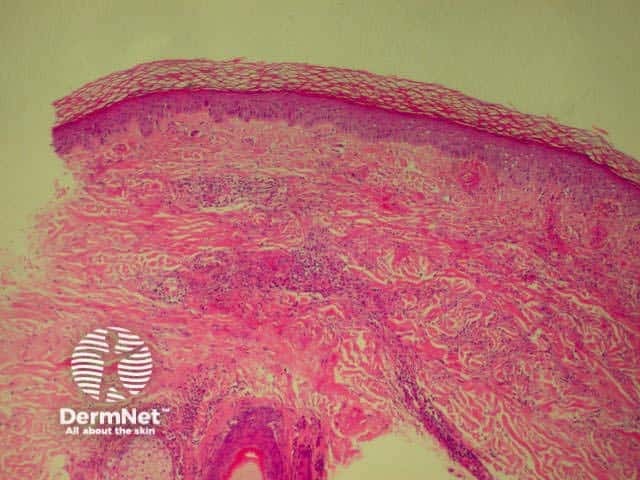 Leucocytoclastic vasculitis