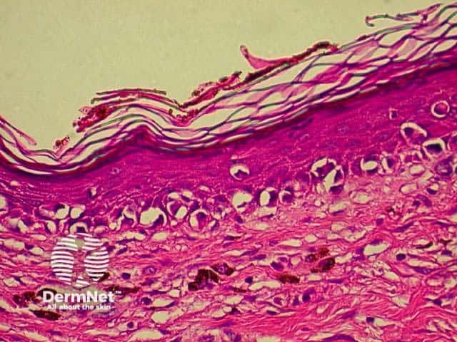 Spindle cell tumour