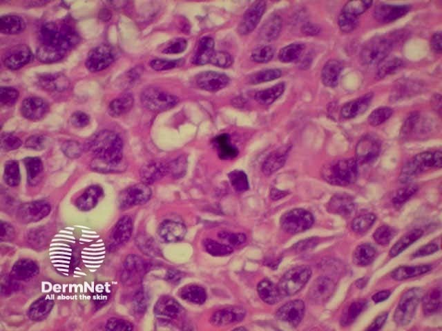 Pathology of Superficial spreading melanoma