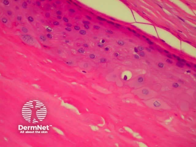 Pathology of pilar cyst