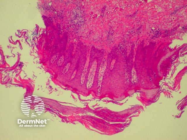 Parakeratosis