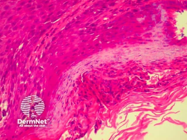 Parakeratosis