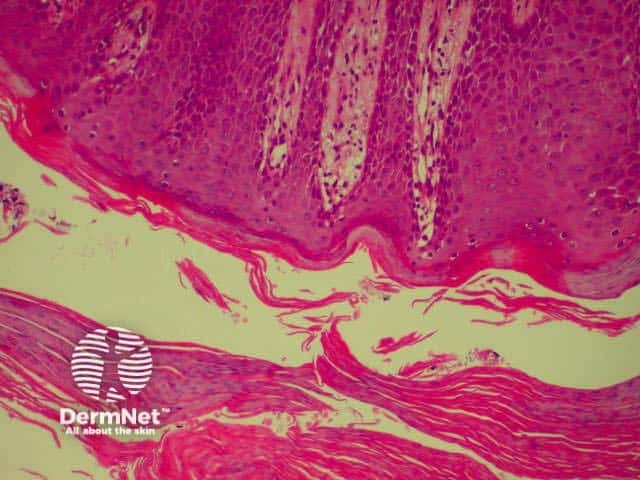 Parakeratosis