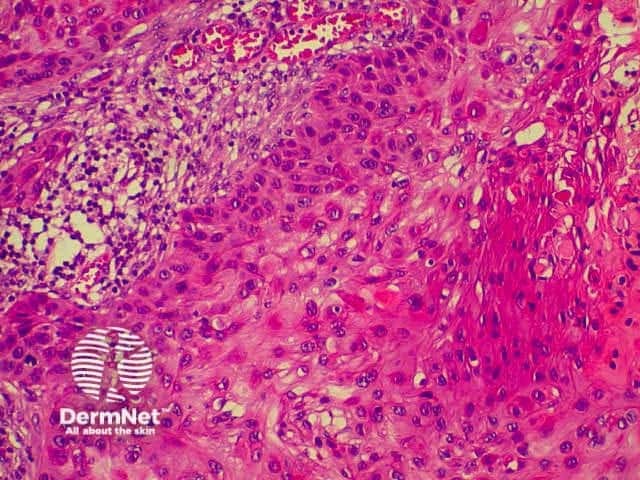 Pathology of SCC