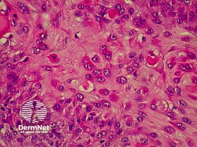 Pathology of SCC