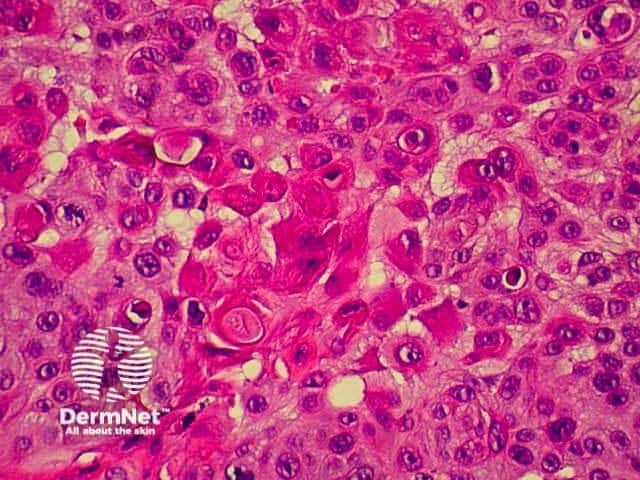 Pathology of SCC