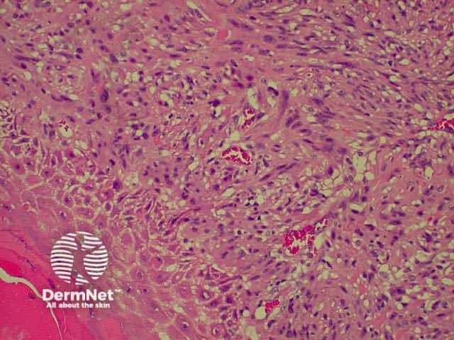 Pathology of melanoma