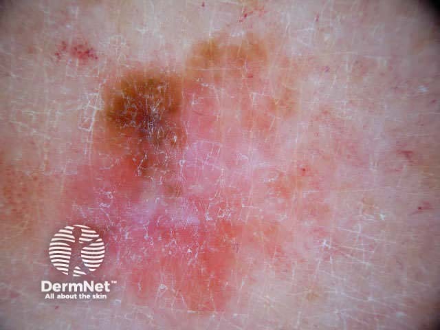 Melanoma in situ