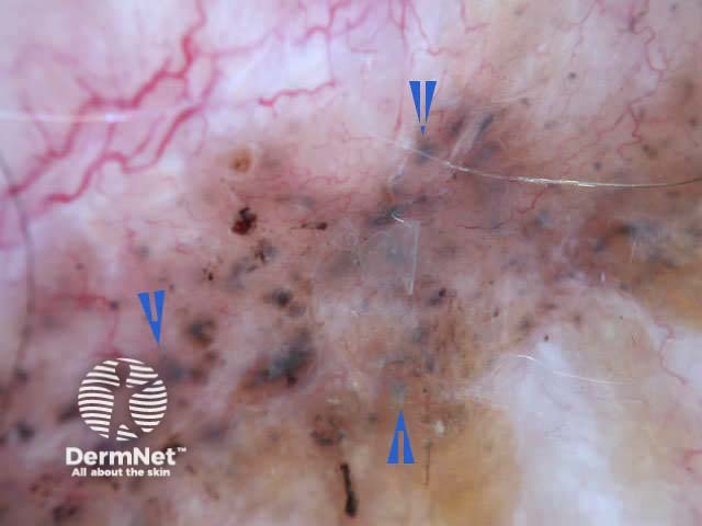 Basal cell carcinoma