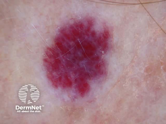 Cherry angioma