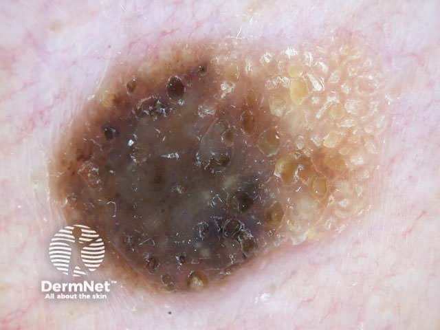 Seborrhoeic keratosis